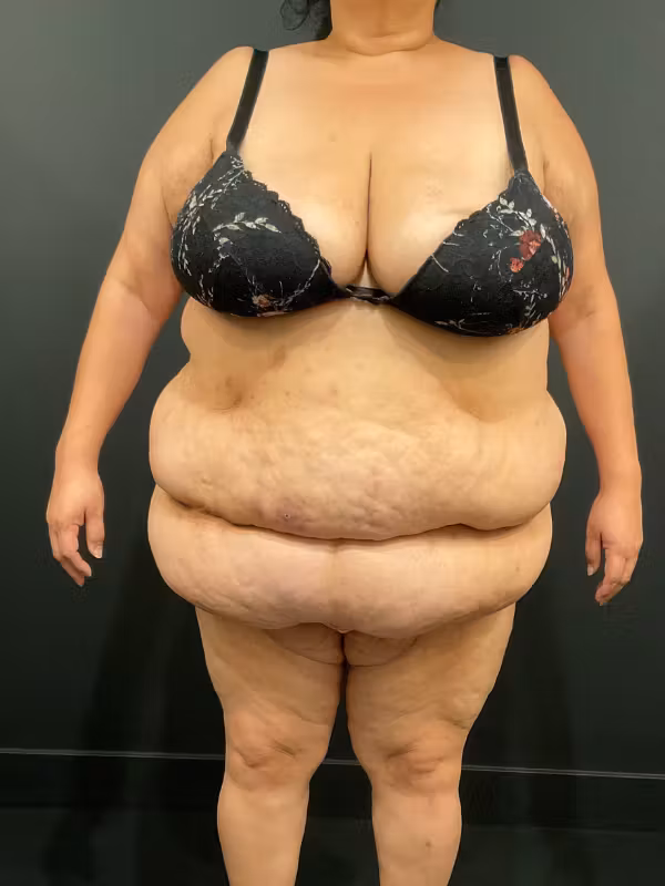Before Image: Plus Size Tummy Tuck - front