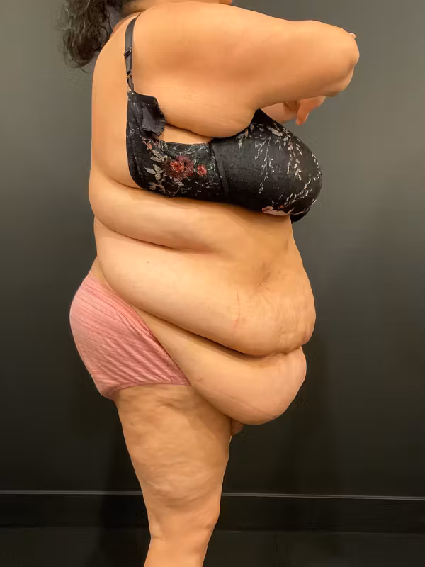 Before Image: Plus Size Tummy Tuck - right-side