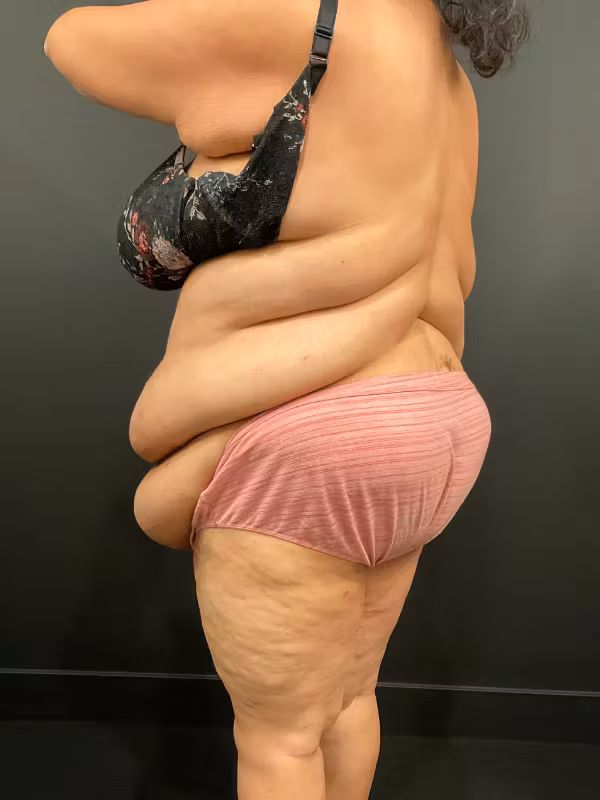 Before Image: Plus Size Tummy Tuck - left-back-oblique