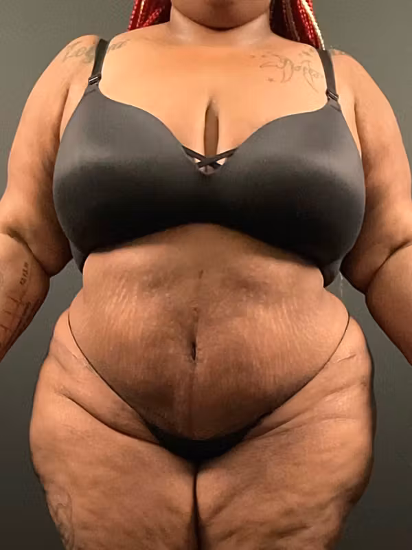 After Image: Plus Size Tummy Tuck - front
