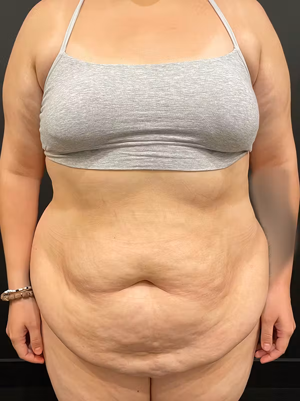 Before Image: Tummy Tuck - front