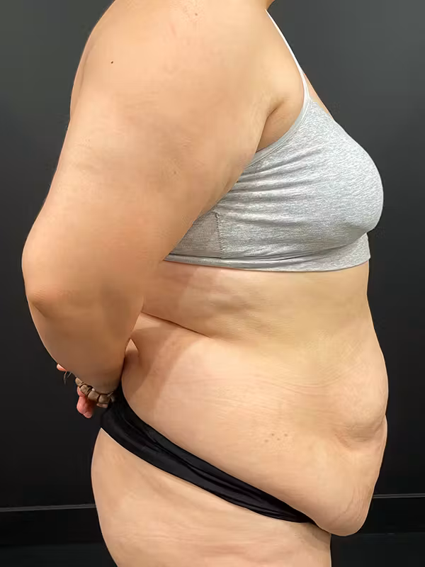 Before Image: Tummy Tuck - right-side