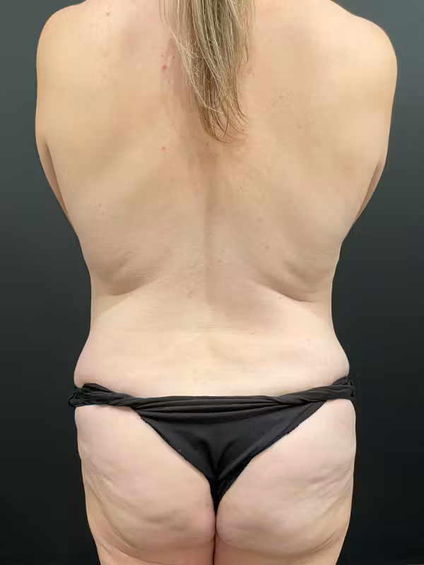 Before Image: Tummy Tuck - back