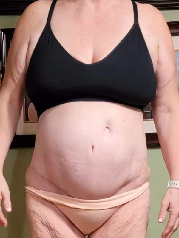 After Image: Tummy Tuck - front