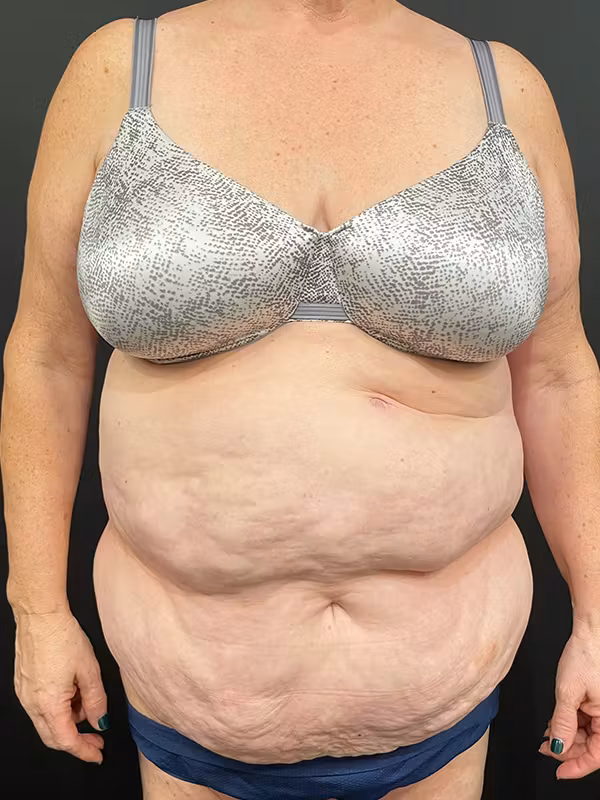 Before Image: Tummy Tuck - front