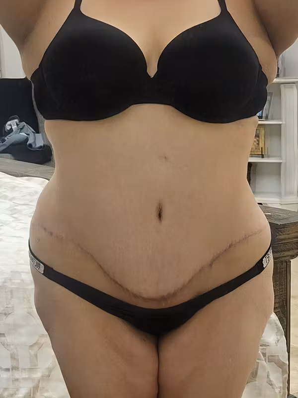After Image: Plus Size Tummy Tuck - front