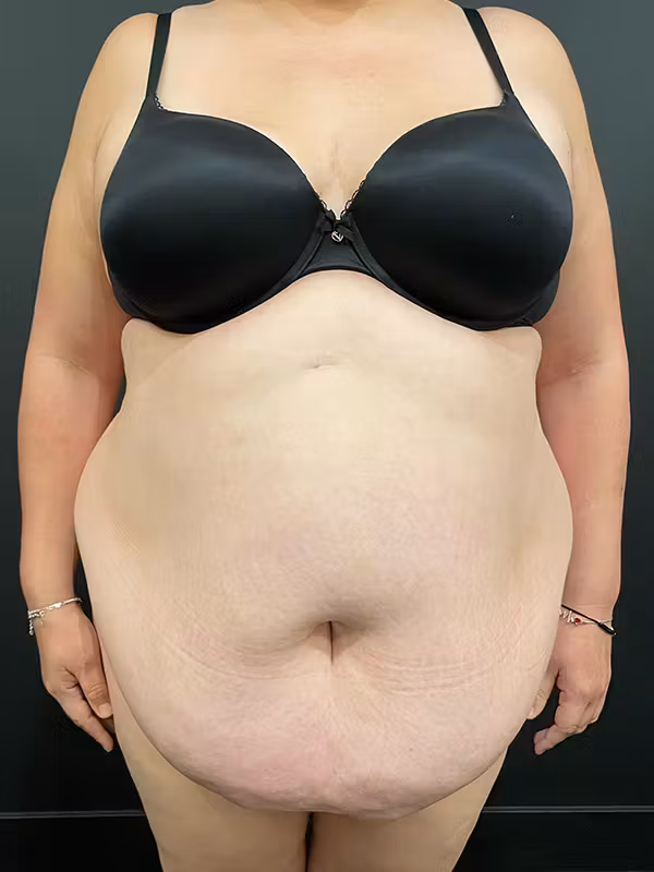 Before Image: Plus Size Tummy Tuck - front