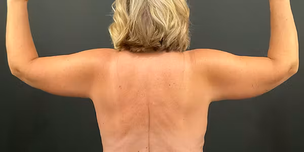 After Image: Arm Lift - back