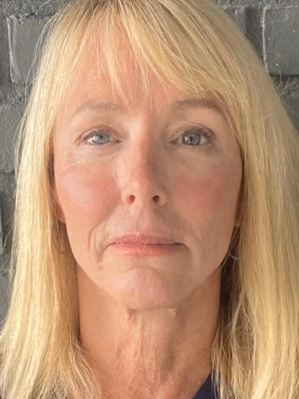 After Image: Facelift - front