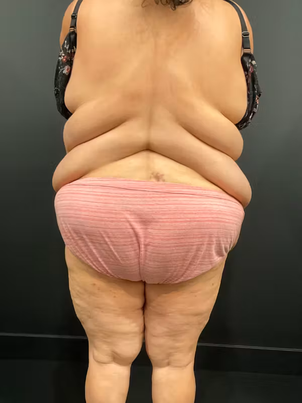 Before Image: Bra Line Back Lift - back