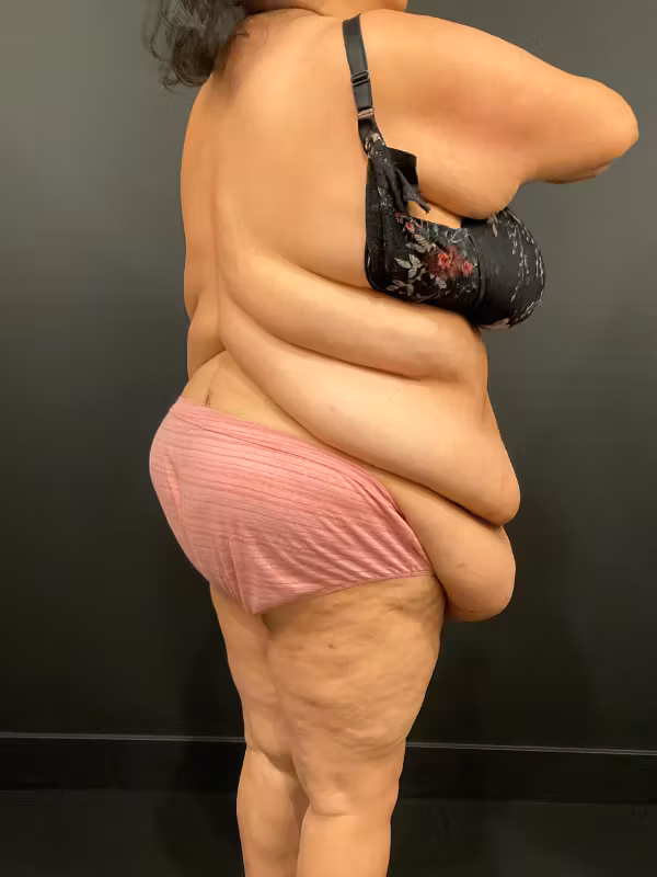 Before Image: Bra Line Back Lift - right-back-oblique