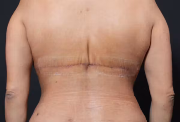 After Image: Bra Line Back Lift - back