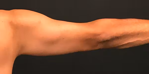 After Image: Arm Lift - back