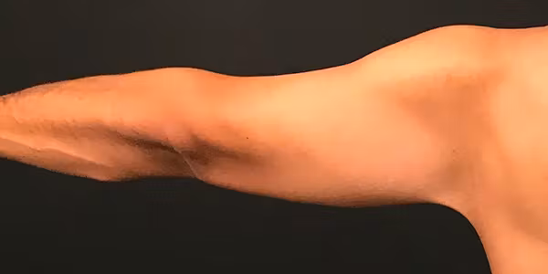 After Image: Arm Lift - back