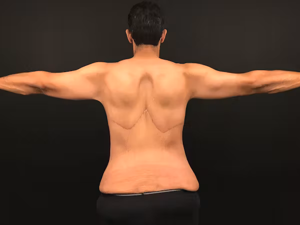 After Image: Arm Lift - back