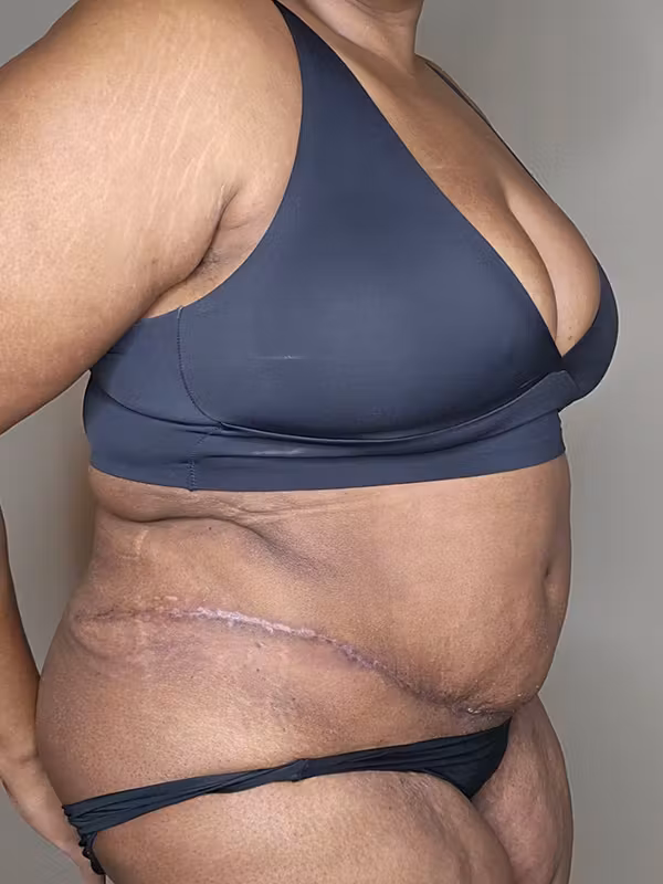 After Image: Plus Size Tummy Tuck - right-front-oblique