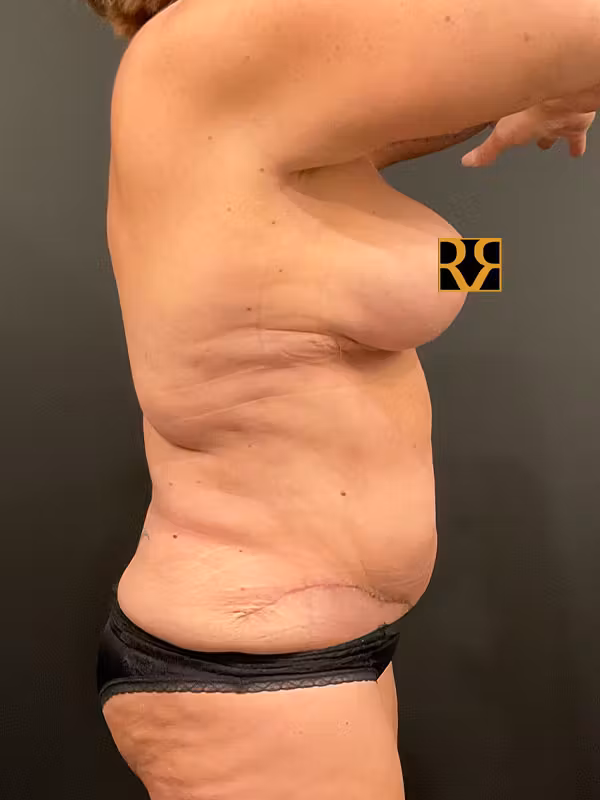 After Image: Tummy Tuck - right-side