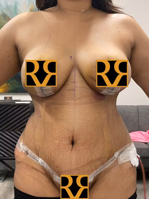 After Image: Tummy Tuck - front