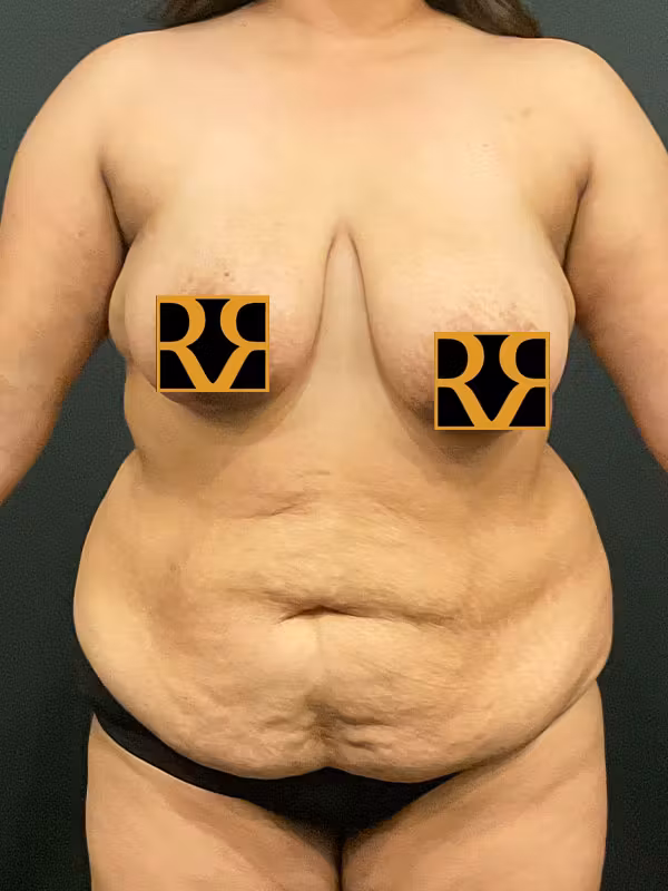 Before Image: Tummy Tuck - front