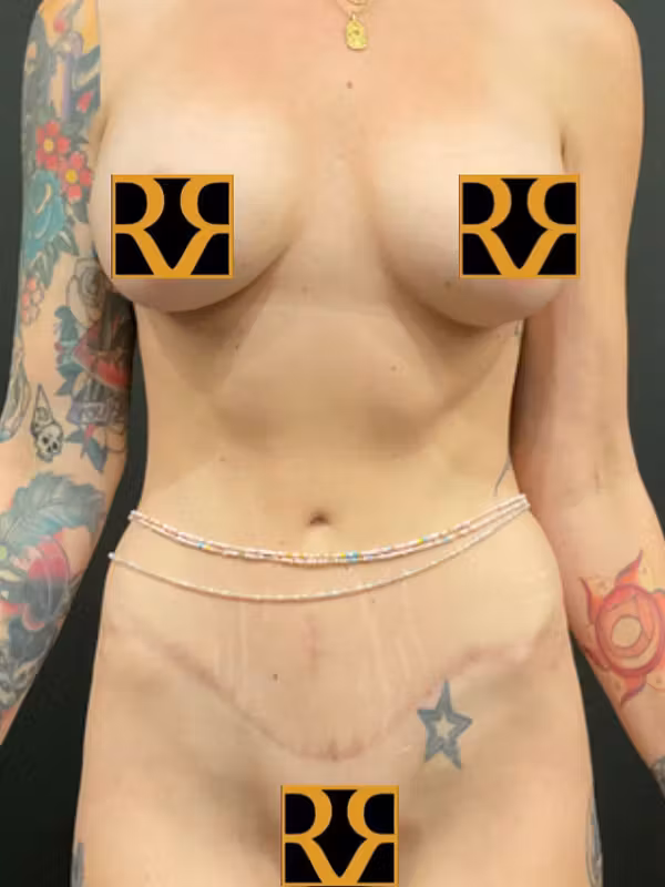 After Image: Tummy Tuck - front