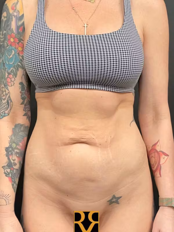 Before Image: Tummy Tuck - front