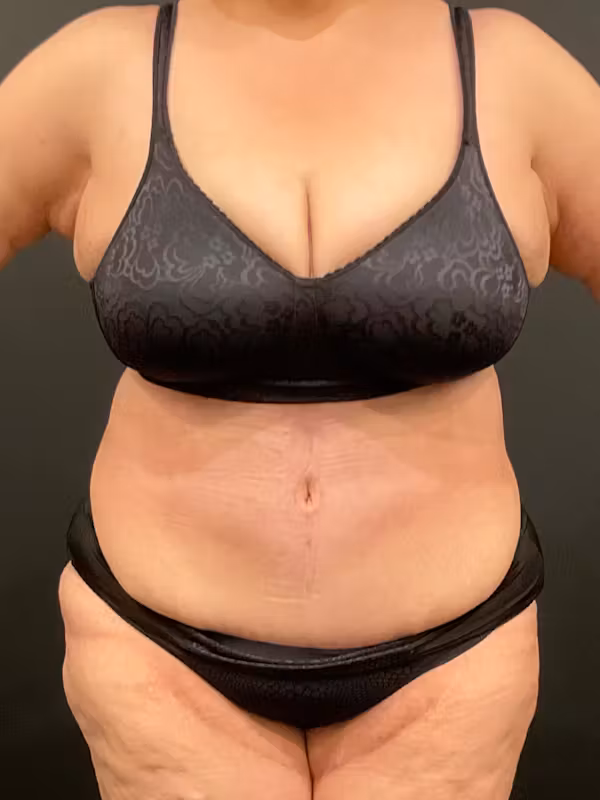 After Image: Plus Size Tummy Tuck - front