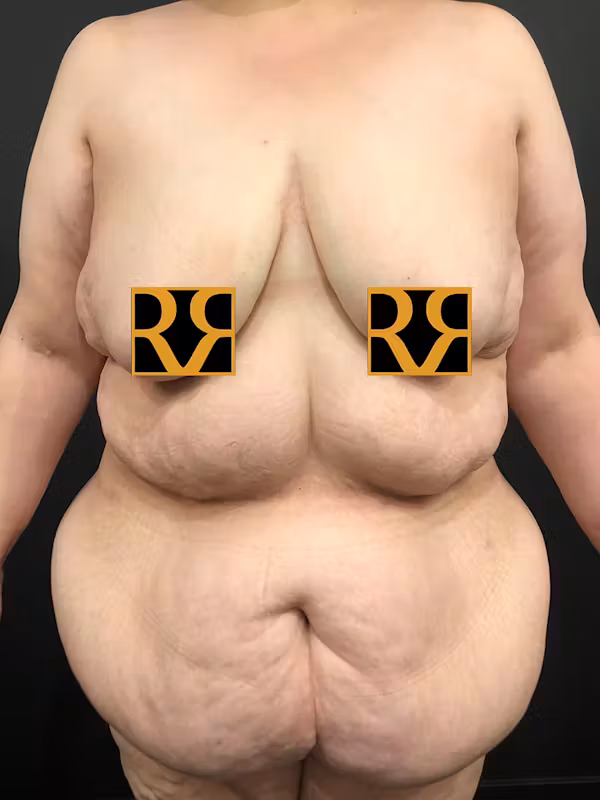 Before Image: Plus Size Tummy Tuck - front