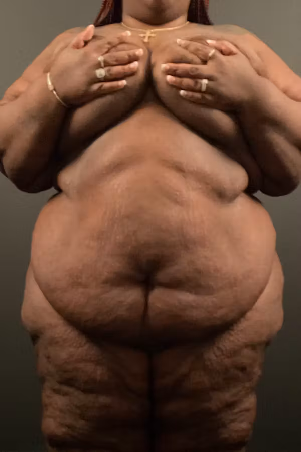 Before Image: Plus Size Tummy Tuck: Week After Surgery - front