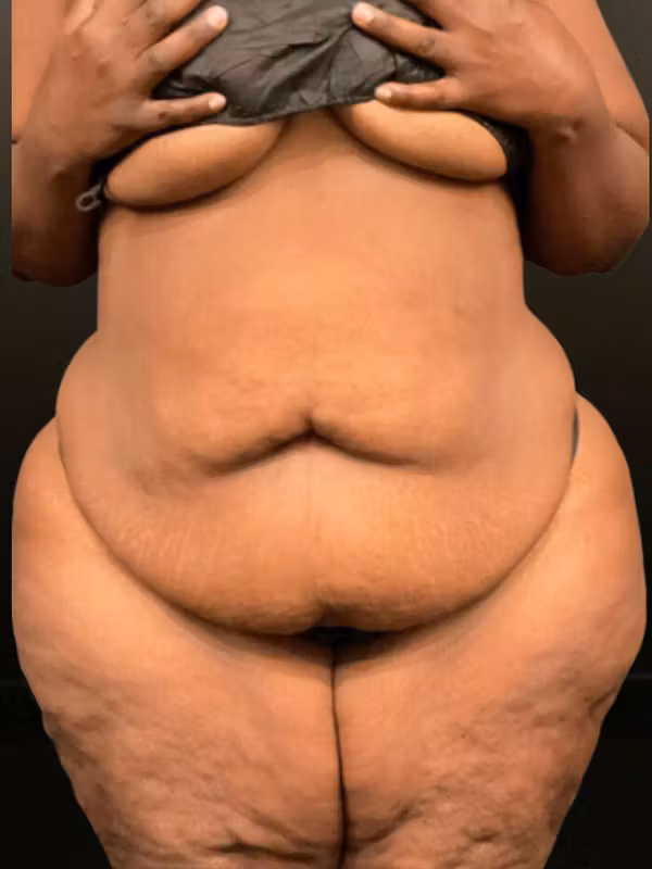 Before Image: Plus Size Tummy Tuck: Week After Surgery - front