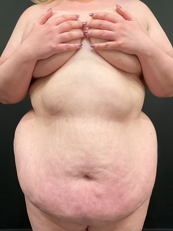 Before Image: Plus Size Tummy Tuck: Week After Surgery - front