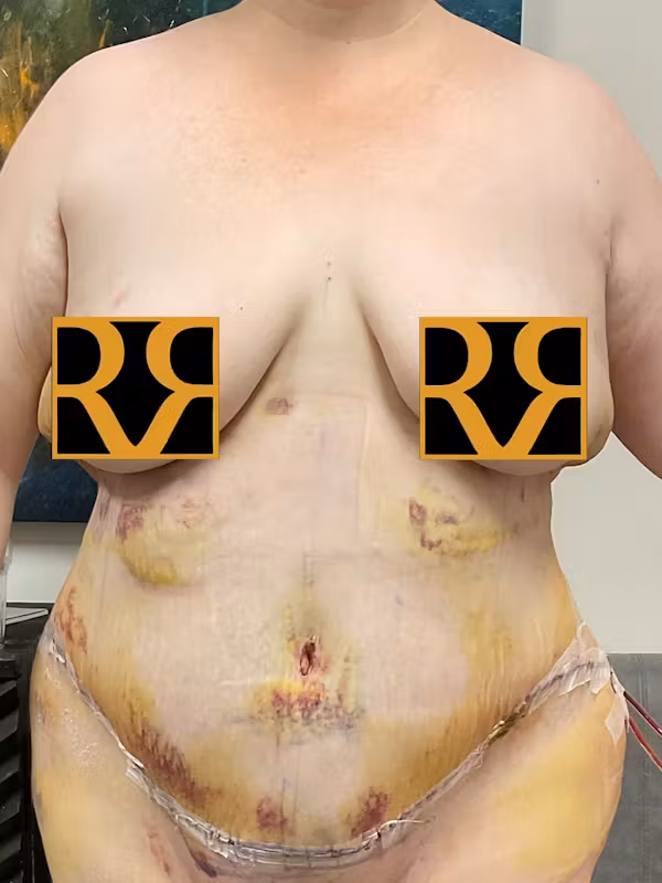 After Image: Plus Size Tummy Tuck: Week After Surgery - front