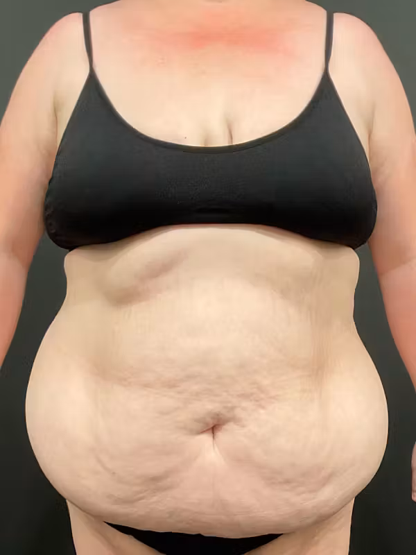 Before Image: Plus Size Tummy Tuck: Day After Surgery - front
