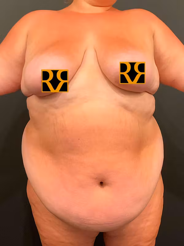 Before Image: Plus Size Tummy Tuck: Week After Surgery - front