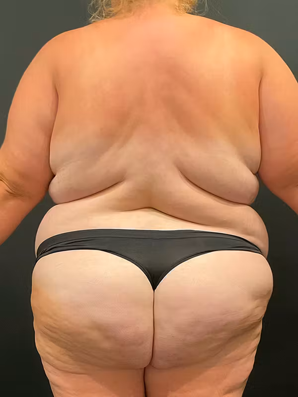 Before Image: Plus Size Tummy Tuck: Week After Surgery - back