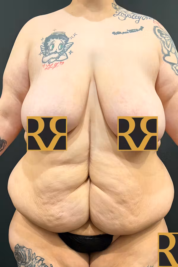 Before Image: Plus Size Tummy Tuck: Day After Surgery - front