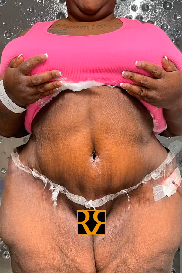 After Image: Plus Size Tummy Tuck - front