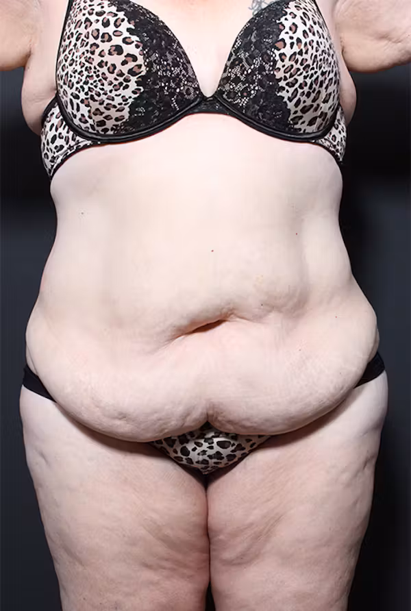 Before Image: Plus Size Tummy Tuck - front