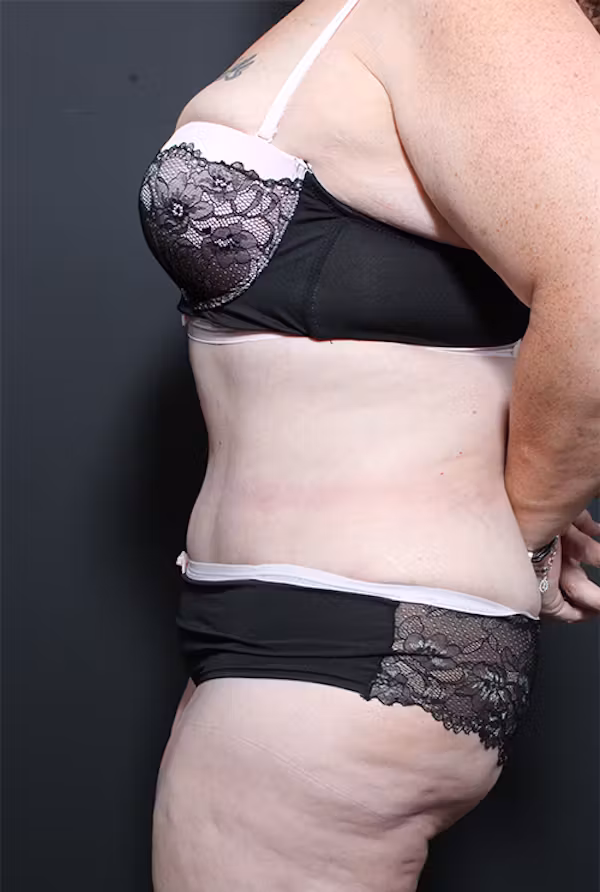 After Image: Plus Size Tummy Tuck - left-side