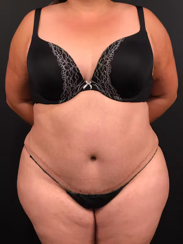 After Image: Plus Size Tummy Tuck - front