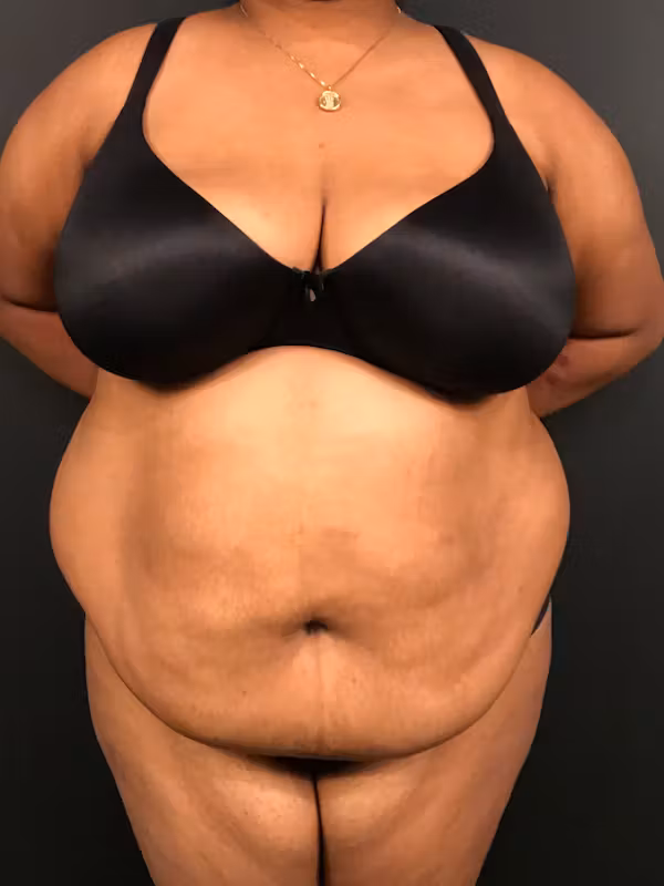 Before Image: Plus Size Tummy Tuck - front