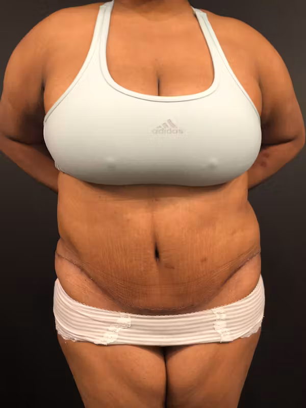 After Image: Plus Size Tummy Tuck - front