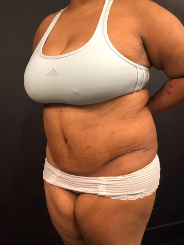 After Image: Plus Size Tummy Tuck - left-front-oblique