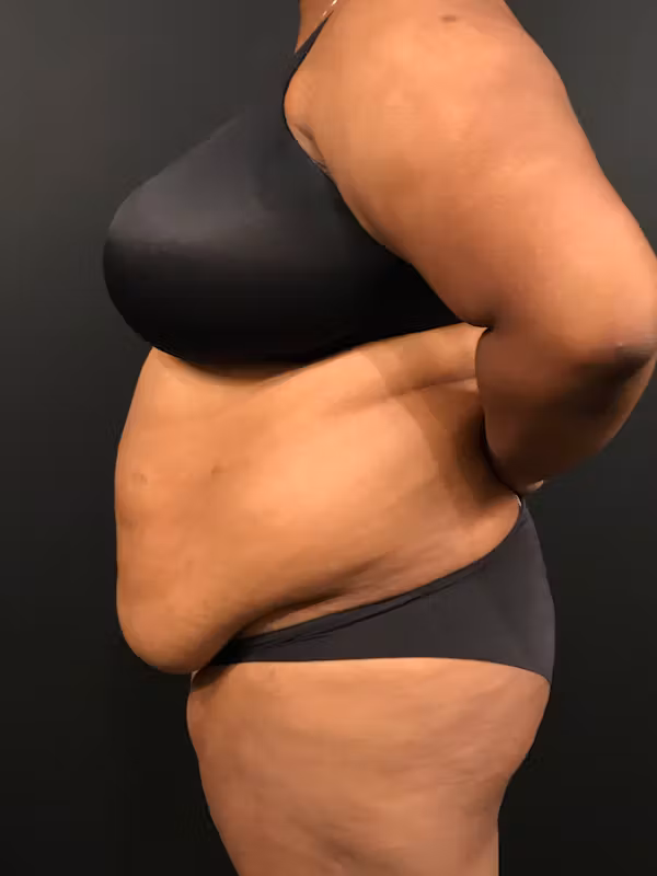 Before Image: Plus Size Tummy Tuck - left-side