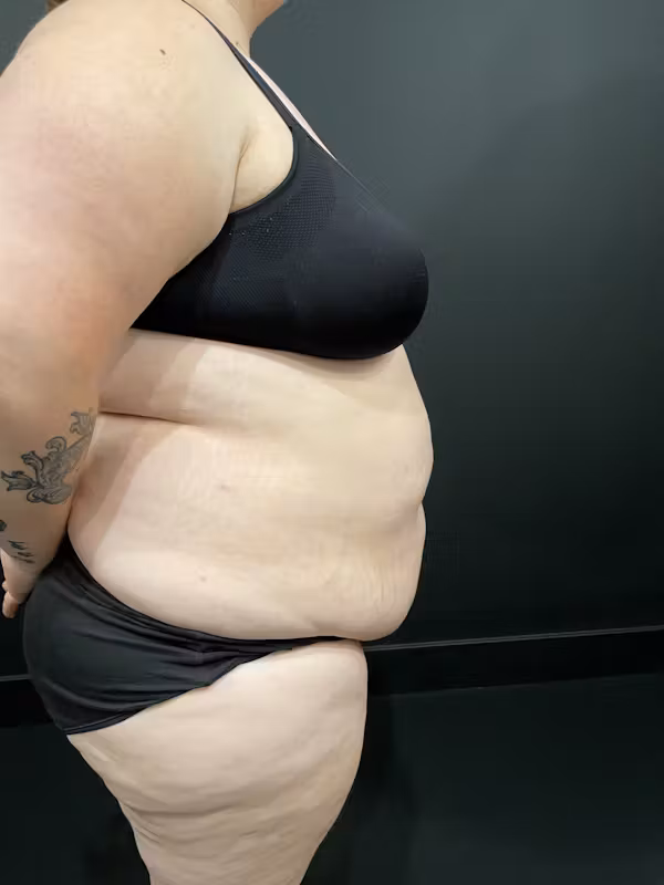 Before Image: Plus Size Tummy Tuck - right-side