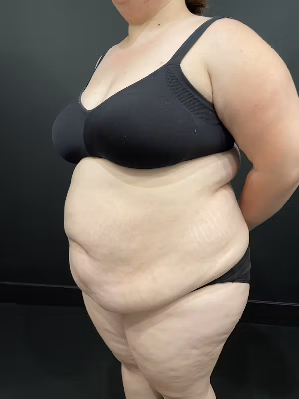 Before Image: Plus Size Tummy Tuck - left-front-oblique