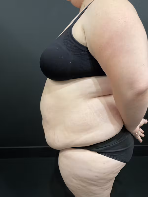 Before Image: Plus Size Tummy Tuck - left-side