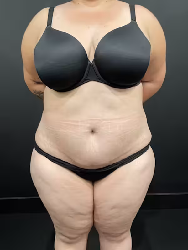 After Image: Plus Size Tummy Tuck - front