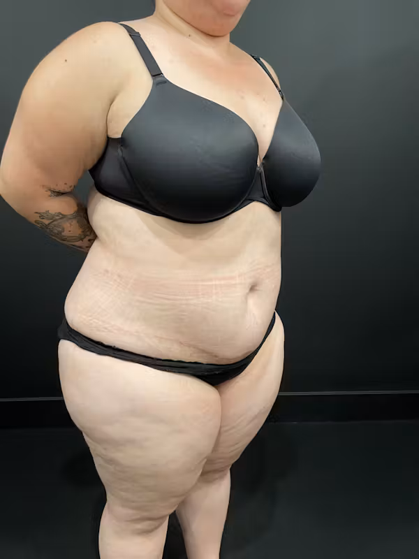 After Image: Plus Size Tummy Tuck - right-front-oblique