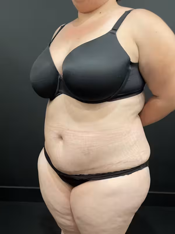 After Image: Plus Size Tummy Tuck - left-front-oblique