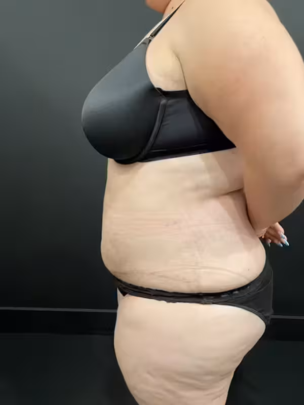 After Image: Plus Size Tummy Tuck - left-side